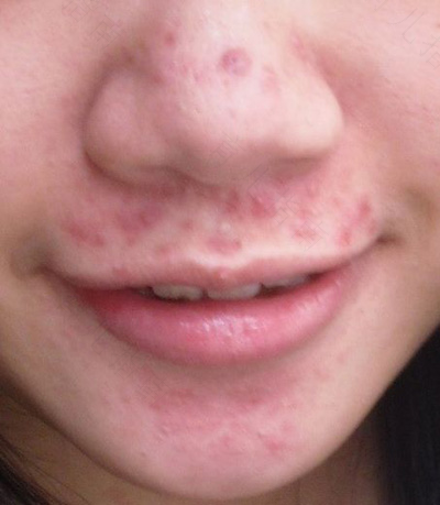 嘴角痤疮怎么治疗