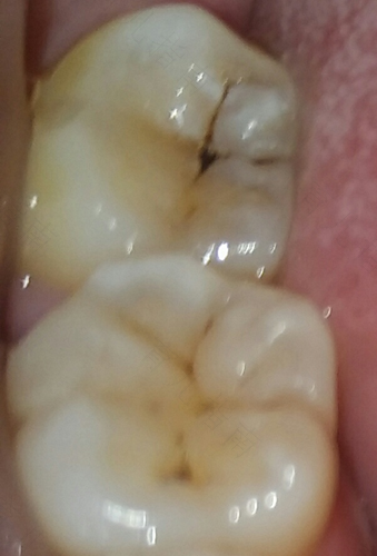 后槽牙黑线一定要补牙吗 后槽牙黑线一定要补牙吗