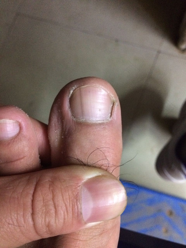 大脚趾长黑点怎么回事 大脚趾长黑点怎么回事