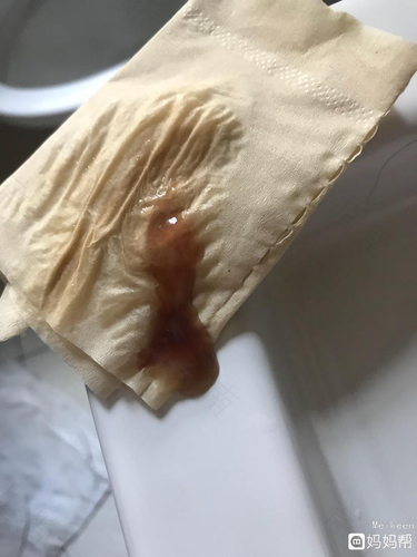 孩子老是有黄鼻涕怎么回事 孩子老是有黄鼻涕怎么回事