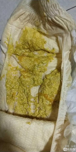 孩子大便像鼻涕是怎么回事 孩子大便像鼻涕是怎么回事