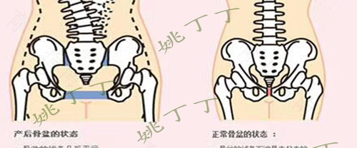 骨盆错位的症状图片 骨盆错位的症状图片
