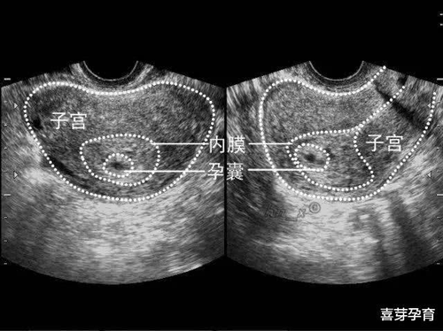 子宫附件囊性结构是什么意思 子宫附件囊性结构是什么意思