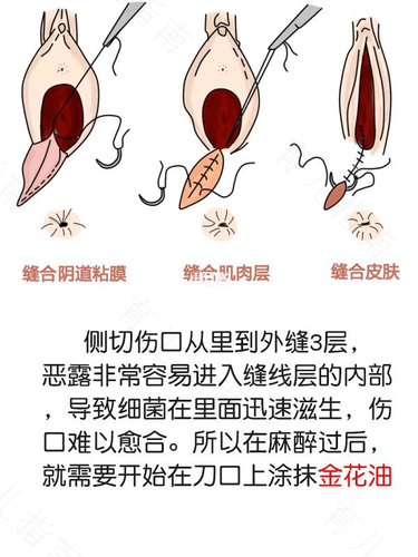 顺产侧切伤口疼痛怎么办 顺产侧切伤口疼痛怎么办