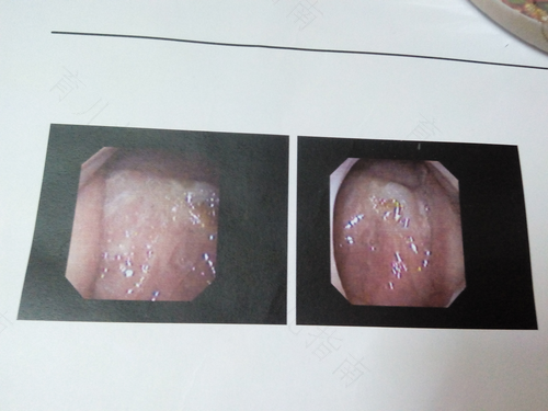 鼻炎引起喉咙有痰要怎么办 鼻炎引起喉咙有痰要怎么办