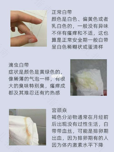 女孩白带多是什么原因 女孩白带多是什么原因