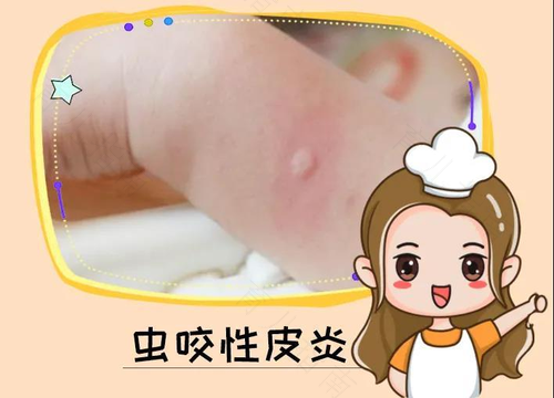 蚊子咬！痱子恼！怎么为宝宝驱散才好