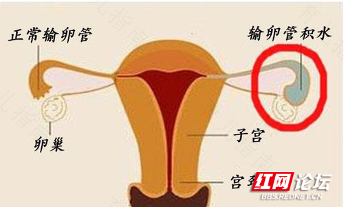 孕后发现患了输卵管肿瘤怎么办