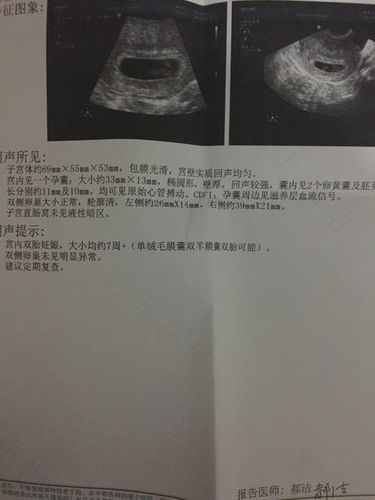 实话告诉你 怀双胞胎体验如何？