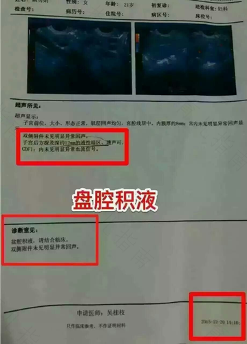 盆腔积液是什么病,严重吗 盆腔积液是什么病,严重吗