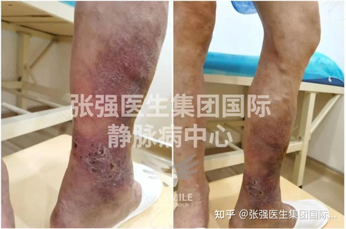 精索静脉曲张怎么办 精索静脉曲张怎么办