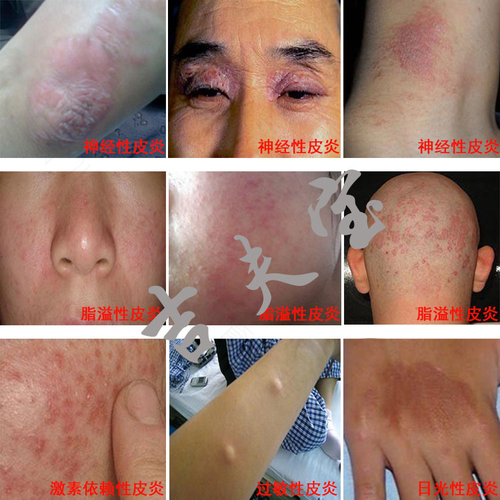 眼皮过敏性皮炎反复发作怎么办 眼皮过敏性皮炎反复发作怎么办