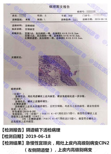 宫颈高度病变还能活多久 宫颈高度病变还能活多久