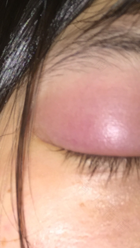 感冒眼睛肿了怎么办