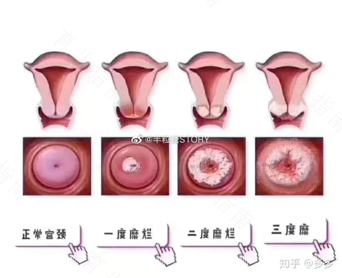 女性宫颈糜烂能治好吗 女性宫颈糜烂能治好吗