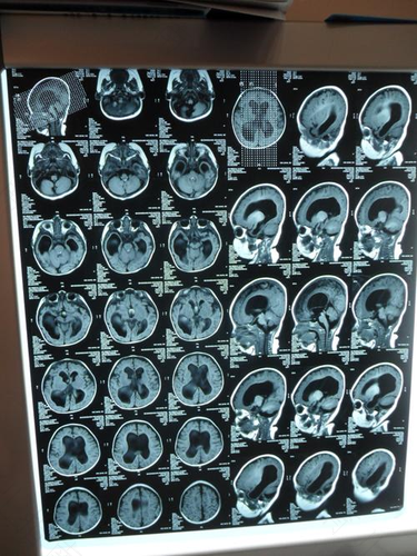 小孩子脑积水是什么造成的 小孩子脑积水是什么造成的