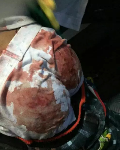 拉肚子擦屁股疼有血怎么回事 拉肚子擦屁股疼有血怎么回事