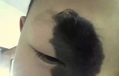 黑色胎记会癌变吗?