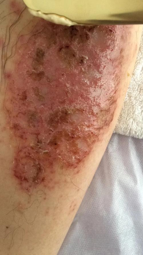 治疗湿疹期间可以喝酒吗 治疗湿疹期间可以喝酒吗