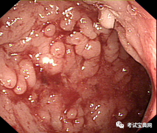 病毒性肠炎怎么治疗 病毒性肠炎怎么治疗