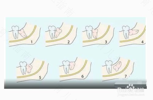 智齿拔牙拆线后注意事项 智齿拔牙拆线后注意事项