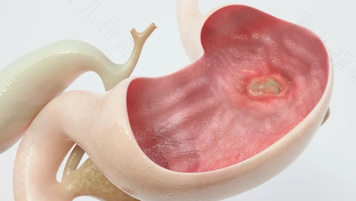 胃溃疡会有粘液便吗