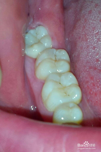 拔智齿一般会渗血多久贴吧 拔智齿一般会渗血多久贴吧