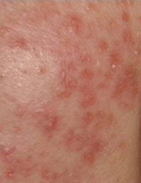 皮肤湿疹流黄水怎么办 皮肤湿疹流黄水怎么办