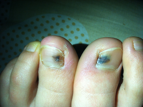 大拇指压伤后变黑怎么办