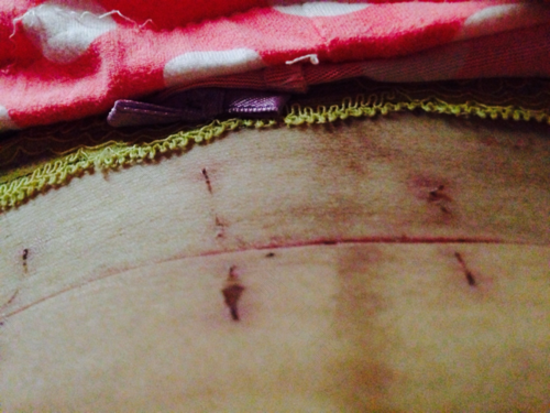 剖腹产两个月伤口痒怎么办 剖腹产两个月伤口痒怎么办