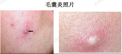 肛门毛囊发炎怎么治疗 肛门毛囊发炎怎么治疗