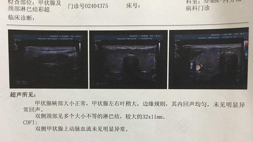 甲状腺b超4a类是什么意思 甲状腺b超4a类是什么意思