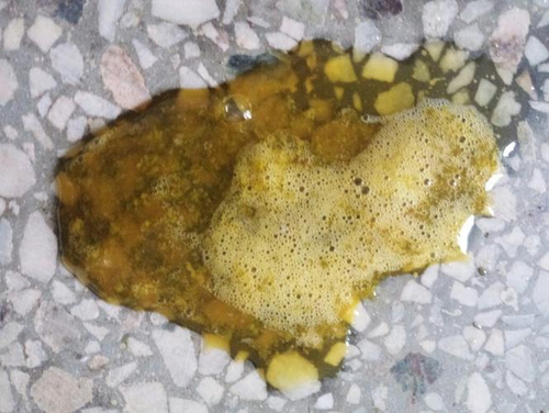 大便有泡沫怎么办 大便有泡沫怎么办