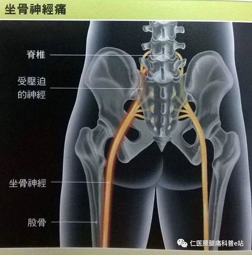 腰椎左侧疼痛是怎么回事 腰椎左侧疼痛是怎么回事