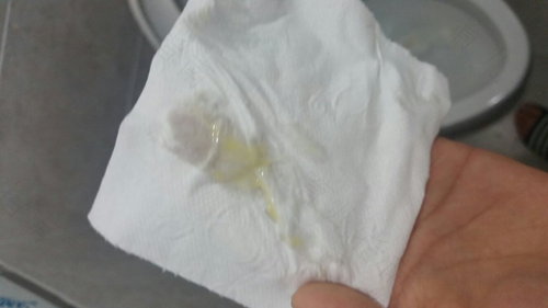 鼻涕绿色变黄怎么回事 鼻涕绿色变黄怎么回事