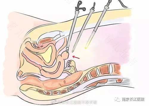 输卵管导丝效果好吗 输卵管导丝效果好吗