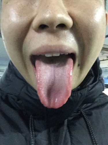 白色念珠菌感染舌头怎么办 白色念珠菌感染舌头怎么办