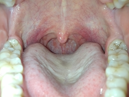 喉咙发炎发烧吃什么好得快 喉咙发炎发烧吃什么好得快