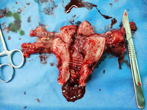 子宫癌可以吃羊肉吗 子宫癌可以吃羊肉吗