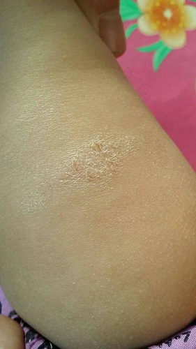 身上起癣了怎么办