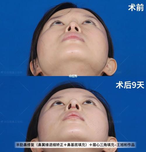 整形失败后再修复要谨慎