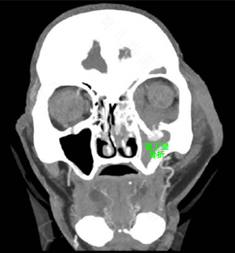 被打眼眶骨折怎么办 被打眼眶骨折怎么办