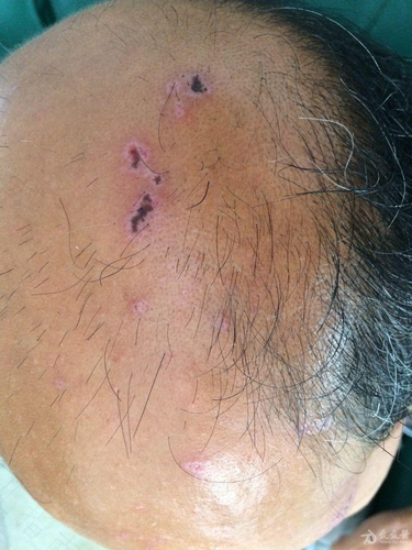 头部带状疱疹神经痛怎么办 头部带状疱疹神经痛怎么办