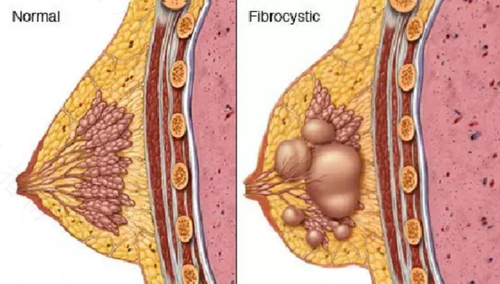 乳腺囊肿会疼吗 乳腺囊肿疼痛怎么办