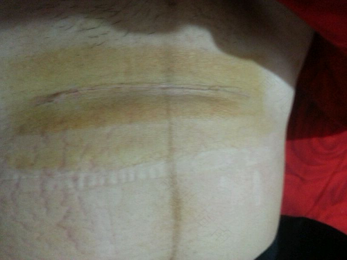 剖腹产伤口有线头怎么办 剖腹产伤口有线头怎么办