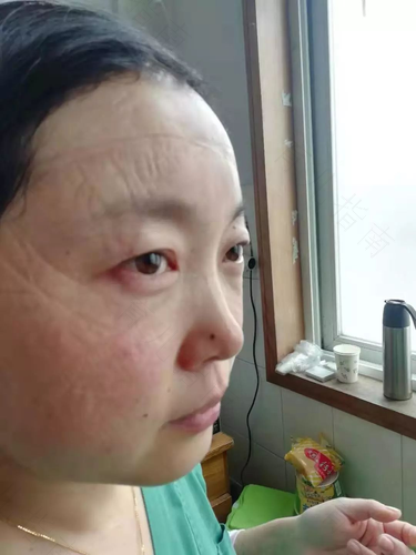 过敏喘不上气怎么办 过敏喘不上气怎么办