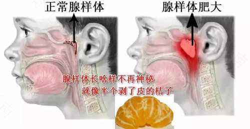 打鼾声音是嘴巴还是鼻子发出来的 打鼾声音是嘴巴还是鼻子发出来的