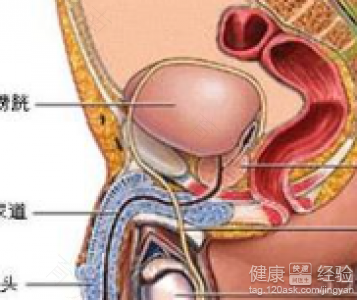 前列腺结石能治愈吗