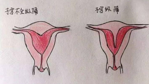 弓形子宫是什么原因 弓形子宫是什么原因