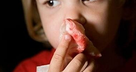 流鼻血用纸塞住有用吗 流鼻血用纸塞住有用吗